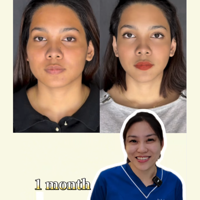 Profhilo Johor Bahru (JB) | Aesthetic Clinic Johor Bahru (JB) | Aesthetic Treatment Johor Bahru (JB)